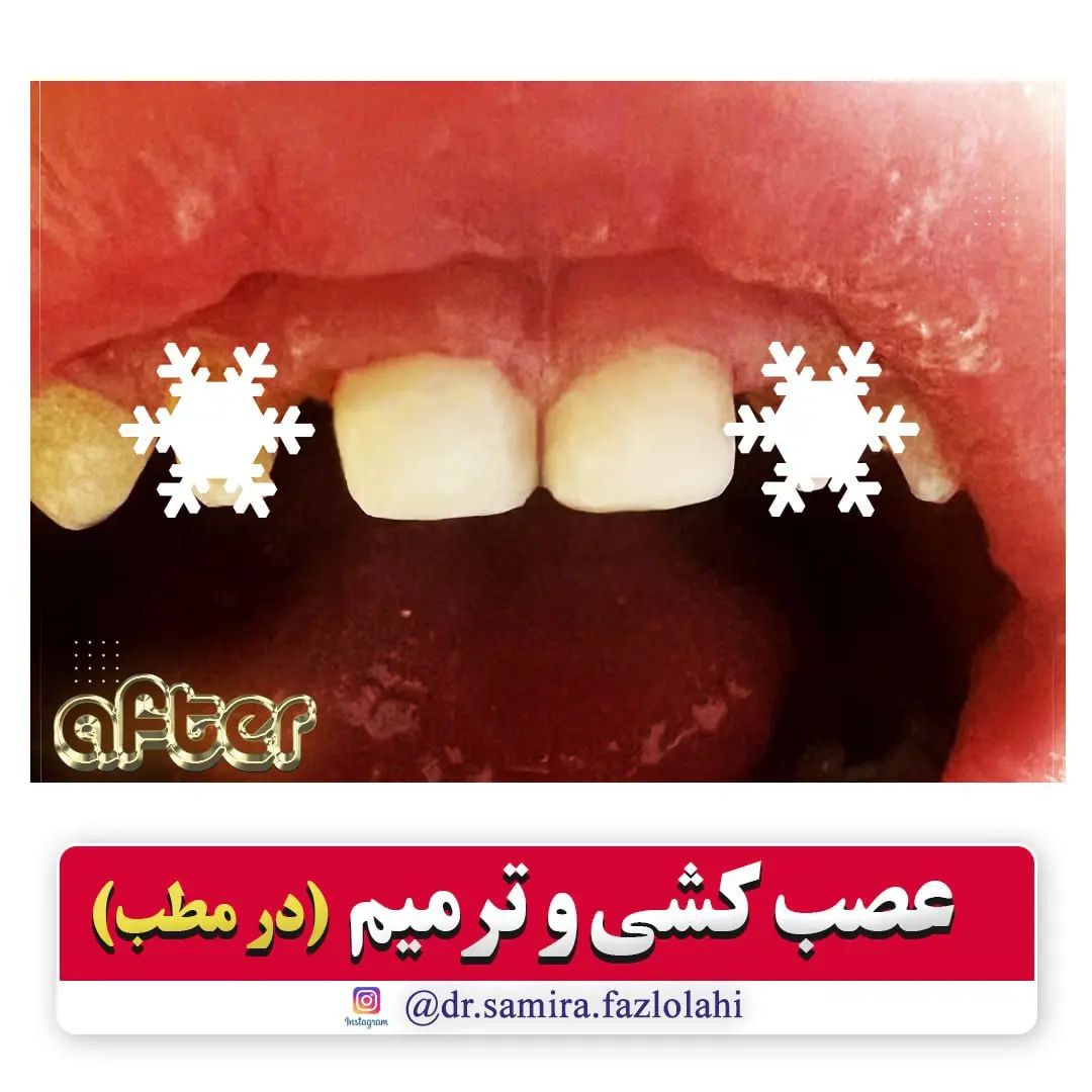 عصب کشی