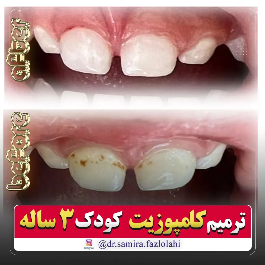 کامپوزیت دندان
