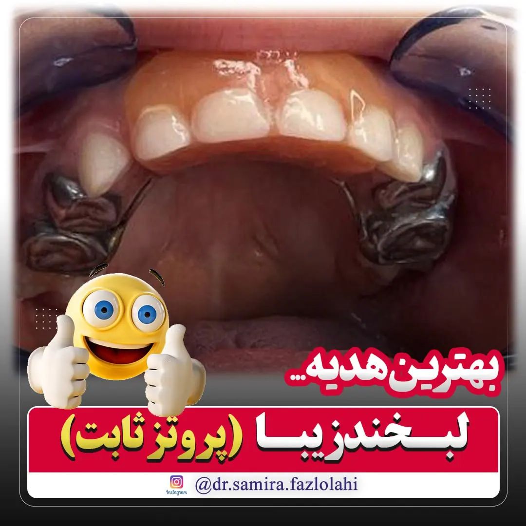 پروتز ثابت کودکان