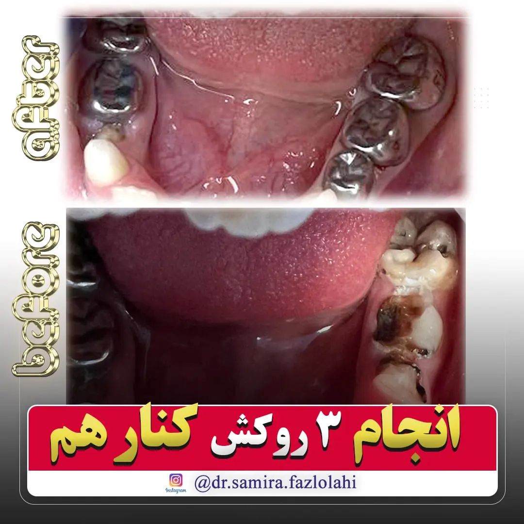 خدمات روکش