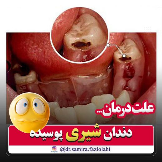 علت درمان دندان شیری پوسیده